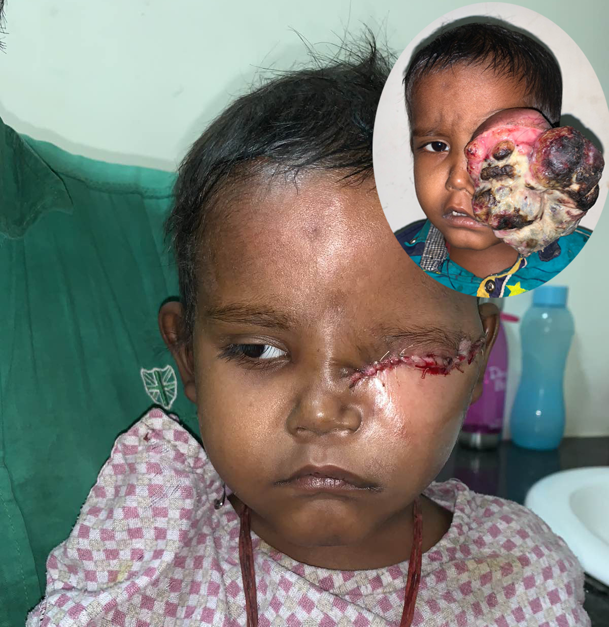 तिलगंगामा सफल भएको चमत्कारिक शल्यक्रिया